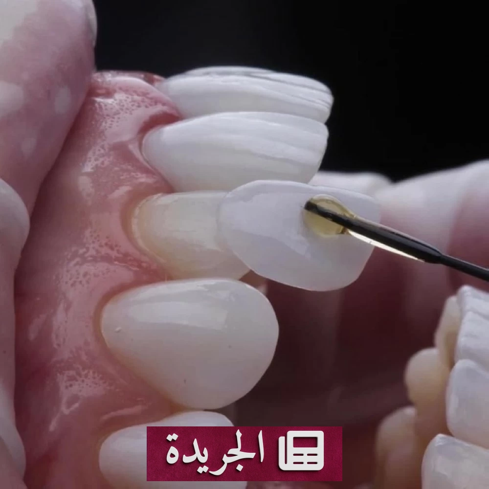 عدسات الأسنان: الابتسامة المثالية بين الجماليات والتحديات الصحية - أخبار أونلاين