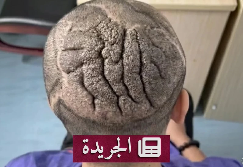 عملية جراحية معقدة تنهي معاناة شاب صيني من فروة رأس تشبه الدماغ - أخبار أونلاين
