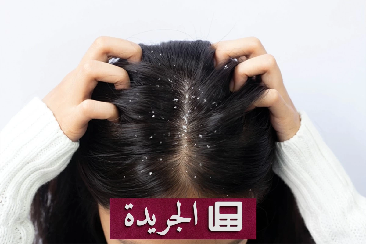 اكتشاف طبي مفاجئ.. هل تسبب قشرة الرأس في تساقط الشعر حقاً؟ - آخر الأخبار - الجريدة