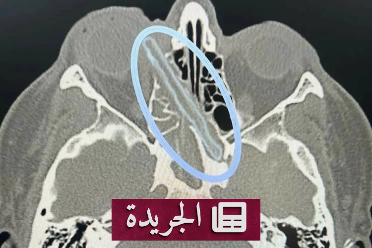 اكتشاف طبي صادم غصناً خشبياً داخل جمجمة رجل روسي - أخبار أونلاين