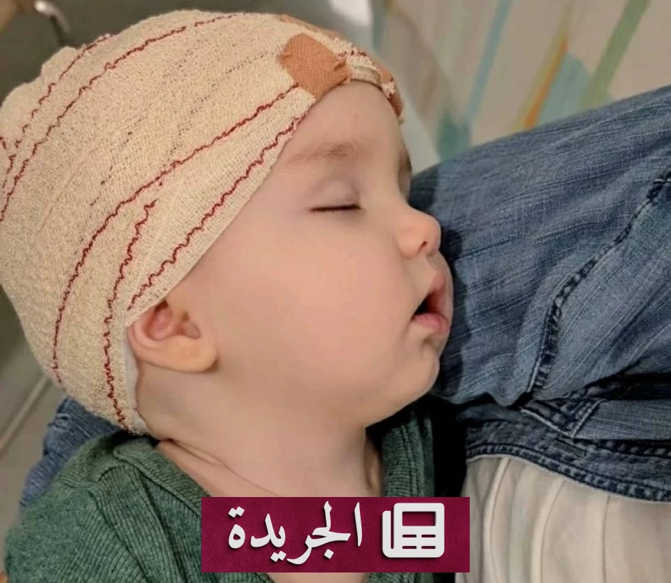 إنجاز طبي غير مسبوق.. جراحة عالمية لإصلاح جمجمة رضيع مشوهة - آخر الأخبار - الجريدة