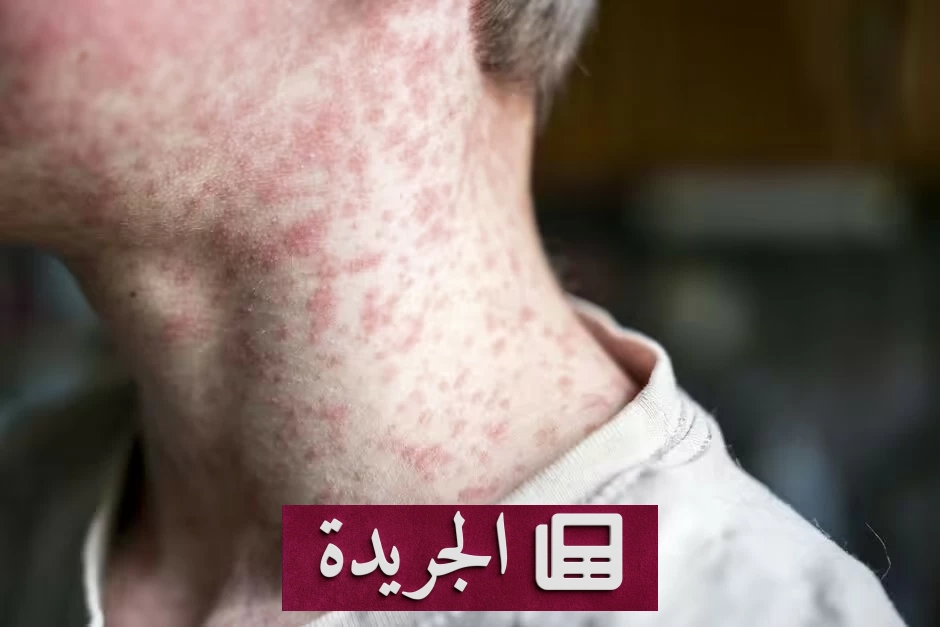 انتشار الحصبة في برمنغهام يثير قلق السلطات البريطانية ويهدد الصحة العامة - أخبار أونلاين