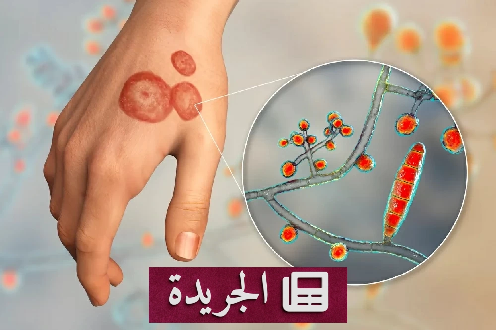 انتشار فطر جلدي مقاوم للعلاج يثير قلق الأطباء عالمياً - آخر الأخبار - الجريدة