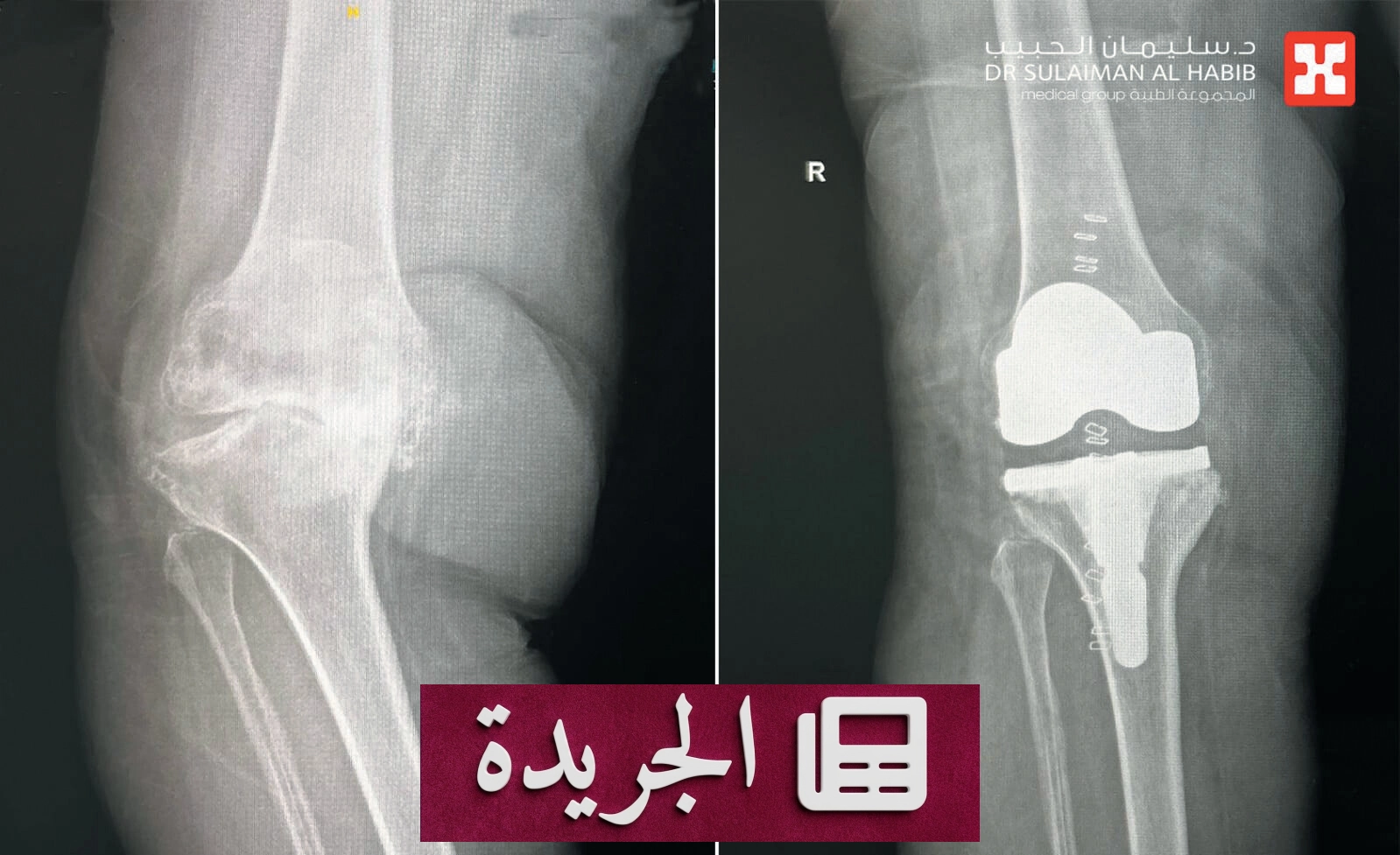 استعادة القدرة على المشي بعد عشر سنوات من الجلوس على الكرسي المتحرك - آخر الأخبار - الجريدة