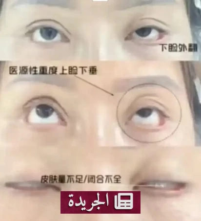 ضحية تشويه جفن العين في الصين تدفع غرامة مالية باهظة بسبب شرط جزائي - أخبار أونلاين