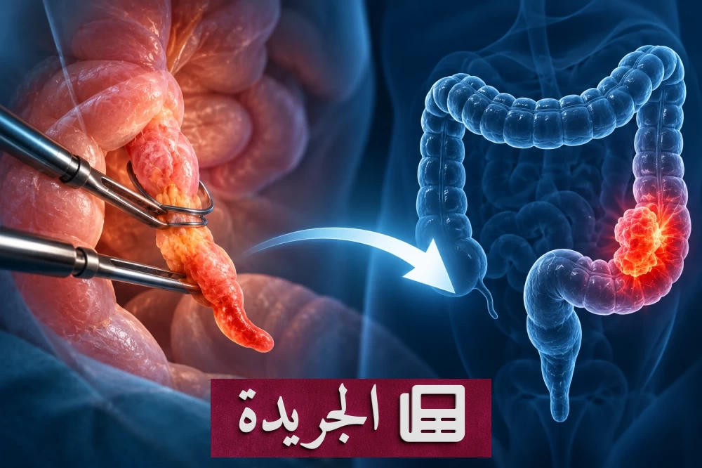 دراسة تكشف دور جراحة الزائدة الدودية في خفض خطر الإصابة بسرطان القولون - آخر أخبار الجريدة