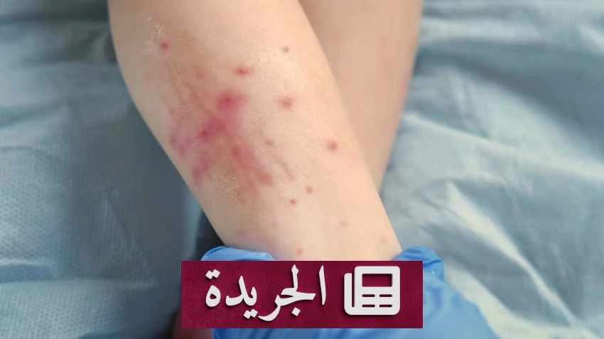 وفاة رابعة في بنسلفانيا جراء الحصبة بين غير الملقحين - آخر الأخبار - الجريدة