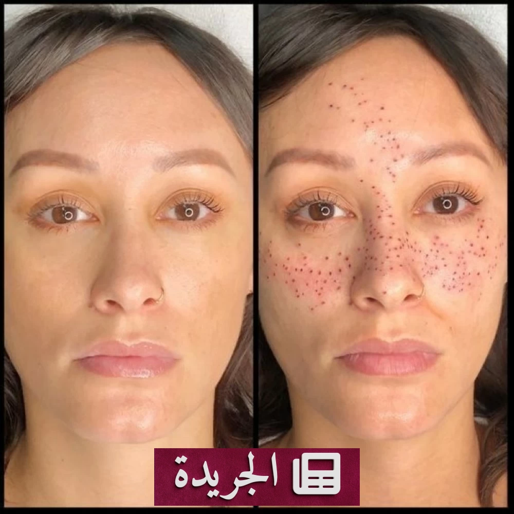 تاتو الكلف بين الجمال الطبيعي والمخاطرة الصحية - أخبار أونلاين